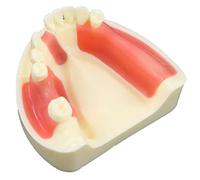 Lpitoy Modèle Dentaire D'implant De Mâchoire Mandibulaire, Modèle Pratique D'étude, Modèle D'enseignement avec Gencive pour Pratique du Lambeau du Perçage