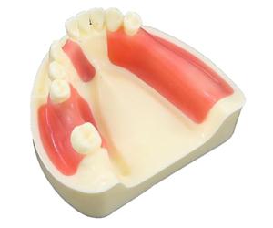 Lpitoy Modèle Dentaire D'implant De Mâchoire Mandibulaire, Modèle Pratique D'étude, Modèle D'enseignement avec Gencive pour Pratique du Lambeau du Perçage