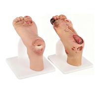Mavdecll Kit De Modèle D'ulcère du Pied Diabétique 2 Pièces, Simulateur De Pied Diabétique en Deux Étapes Niveau 1~3 Léger Et Niveau 4~5 Sévère, Modèle De Pathologie De L'ulcère du Pied