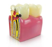 MediTrainer Modèle de dents, modèle de développement de la carie dentaire, recherche en anatomie dentaire et enseignement des soins bucco-dentaires pour les médecins et les patients, l'ensemble du