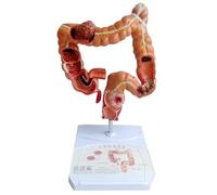 melairo Modèle D'Enseignement, Modèle D'Anatomie Du Gros Intestin Humain, Modèle de Lésion Viscérale, Modèle D'Apprentissage Du Système Digestif Humain