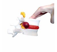 mike dentaires modèle anatomique une vertèbre lombaire disque - prolapsus de l'anatomie médicale