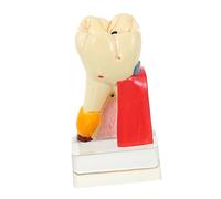 Mikinona Modèle Anatomique de Carie Modèle Pédagogique de Dents pour Enseignement Oral Outil Démonstration des Caries et Dents