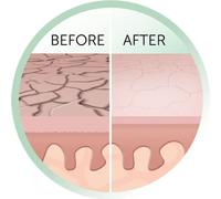 Mikrodermabrasion au diamant REVEAL