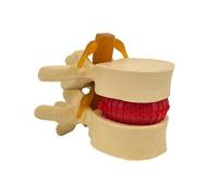Milageto Modèle Prolapsus Discal Discale Lombaire | Orthopédique, Modèle Vertèbres Lombaires Disques Intervertébraux, pr Laboratoire D'anatomie, Orthopédistes