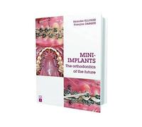 Mini-Implants: The Orthodontics of the Future