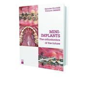 Mini-implants: The Orthodontics of the Future by Skander Ellouze, François Darqué (2015) Hardcover