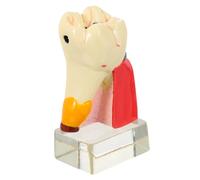 Mipcase Modèle Anatomique Agrandi pour Démonstration Caries Outil Pédagogique pour et Enseignement des Dents