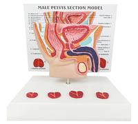 Modèle 3D de vessie et Prostate Masculine Abdominale | Comparez l'anatomie normale et pathologique for une démonstration médicale