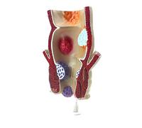 Modèle Anatomique 1.5X modèle de lésion de Fissure de Rectum Humain modèle de pathologie anorectale d'anatomie Humaine