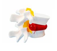 Modèle anatomique agrandi de hernie discale lombaire, modèle de squelette humain mobile for l'enseignement et l'apprentissage Moules pédagogiques