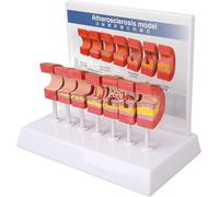 Modèle anatomique artériel 7PCS, modèle anatomique vasculaire, amplification artérioveineuse pathologique, outil pédagogique sur le processus de thrombose et d'athérosclérose.