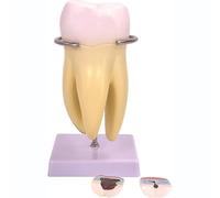 Modèle Anatomique Comparatif Caries Dentaires, Modèle D'étude L'anatomie Dentaire avec Base, Conception Réaliste, 3 Dents Cariées Amovibles Et 6 Parties du Nerf Dentaire pour Dentistes