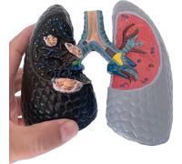 Modèle anatomique comparatif entre un poumon sain et un poumon de fumeur, support pédagogique sur l'anatomie du poumon humain
