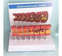 Modèle anatomique d'assemblage du thrombus de l'athérosclérose de l'artère | Modèle de vaisseau de l'artère humaine for les études, affichage, enseignement avec Description en anglais