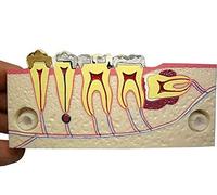 Modèle anatomique de dents dentaires Analyse détaillée de l'étude Implants dentaires à des fins éducatives Démonstration de la structure de décomposition
