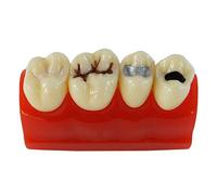 Modèle Anatomique De Dents, Modèle Pédagogique pour Dents Dentaires avec Fermeture De Puits Et De Rainures, pour L'éducation des Patients