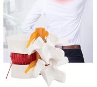 Modèle anatomique de hernie discale lombaire humaine Modèle anatomique de la colonne vertébrale humaine Modèle de démonstration médicale de la colonne lombaire 1:1,5 Colonne lombaire humaine