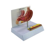 Modèle anatomique de l'estomac pathologique, perforation gastrique, outil pédagogique en salle de classe pour l'enseignement clinique