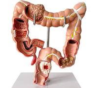 Modèle Anatomique De Pathologie Du Côlon Humain, Modèle Anatomique Du Gros Intestin Humain Grandeur Nature, Modèle De Pathologie Du Côlon, Système Digestif D'anatomie Anatomique Humaine