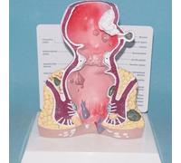 Modèle anatomique de pathologie du rectum humain - Outil pédagogique for les hémorroïdes et les maladies intestinales