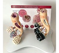 Modèle anatomique de pathologie pulmonaire normale, modèle comparaison poumons sains et pathologiques, d'éducation des patients en classe for les médecins