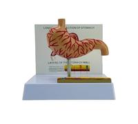 Modèle anatomique de perforation gastrique - Modèle d'anatomie de l'estomac pathologique pour les paramètres cliniques - Rapport de conférence - Accessoire de formation en soins de santé