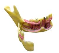 Modèle anatomique dentaire mandibulaire pour l'éducation démontrant les caries buccales et les kystes radiculaires
