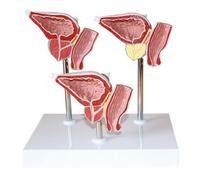 Modèle anatomique des organes urinaires et reproducteurs masculins 1:1 | Modèle de comparaison pathologique de la prostate humaine, modèle d'hypertrophie et de lésion cancéreuse de la prostate