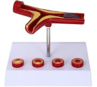 Modèle anatomique des vaisseaux sanguins humains, modèle d'artériosclérose cardiovasculaire, modèle d'athérosclérose, modèle de thrombose humaine à des fins pédagogiques médicales.