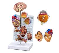 Modèle Anatomique d'hypertension Modèles Miniatures Cerveau, d'œil, cœur, Rein et d'artère Ensemble modèles d'anatomie du Corps Humain Réplique Modèle d'hypertension artérielle Outil pédagogique