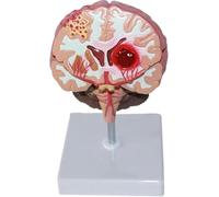 Modèle anatomique du cerveau, accident vasculaire cérébral, hémorragie cérébrale, malformation artério-veineuse cérébrale, modèles d'enseignement de la pathologie cérébrale