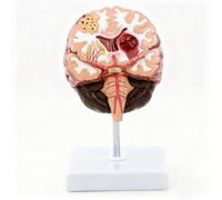 Modèle Anatomique du Cerveau Humain Avec Socle, Modèle de Structure Pathologique du Cerveau, Modèles Pathologiques D'infarctus Cérébral et D'hémorragie Cérébrale pour I'enseignement Médical