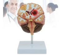 Modèle Anatomique Du Cerveau Humain, Hémorragie Cérébrale, Malformation Artérioveineuse Cérébrale, Modèle Pathologique, Enseignement Médical, Apprentissage en Classe