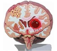Modèle anatomique du cerveau, modèle d'AVC, modèle pathologique d'hémorragie cérébrale et de malformation artérioveineuse cérébrale, modèle de structure cérébrale à l'échelle 1:1