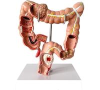 Modèle anatomique du côlon humain, modèle de pathologie du côlon, outil pédagogique anatomique de lésion du côlon du système digestif 1/2 grandeur nature, for l'éducation médicale