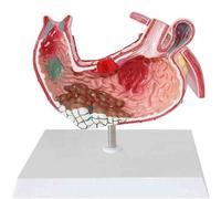 Modèle anatomique en PVC représentant les organes humains : l'estomac, les lésions gastriques, les pathologies gastriques (ulcère, gastrite)