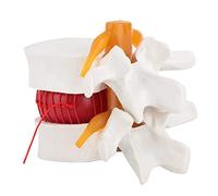 Modèle Anatomique Humain de hernie discale Lombaire, modèle de hernie discale de vertèbres lombaires 1,5 Fois Grandeur Nature pour l'enseignement, l'apprentissage et la