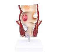 Modèle Anatomique Humain, Outil pédagogique médical for l'enseignement | Modèle interne de maladie colorectale d'hémorroïdes rectales, modèle d'enseignement de pathologie de fissure de fistule