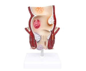 Modèle Anatomique Humain, Outil pédagogique médical for l'enseignement | Modèle interne de maladie colorectale d'hémorroïdes rectales, modèle d'enseignement de pathologie de fissure de fistule