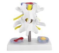 Modèle Anatomique Lombaire, Modèle de Démonstration Lombaire, Modèle de Colonne Lombaire Humaine Avec 2 Disques Intervertébraux Malades pour L'Anatomie et La Physiologie