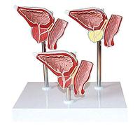 modèle Anatomique Modèle Anatomique du système urinaire Humain, modèle de pathologie la Fissure antérieure, en Trois Parties, for présentation Scolaire