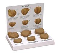 modèle anatomique, Modèle anatomique pathologique contrasté de la prostate masculine - Étude et enseignement des organes humains Modèles anatomiques