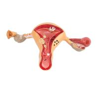 Modèle anatomique pathologique de l'utérus : organe reproducteur féminin grandeur nature avec représentation la maladie