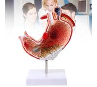 Modèle anatomique pathologique humain de l'estomac avec diaphragme, outil visuel d'aide à l'étude des lésions gastriques Modèle anatomique pour l'enseignement des sciences Modèle médical