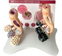 Modèle anatomique pulmonaire humain avec comparaison saine et pathologique pour l'éducation des médecins et des patients