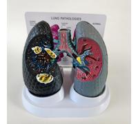 Modèle bronchopulmonaire pour comparaison du tabagisme et des poumons sains, avec dos en anglais, idéal pour les conférences médicales et l'éducation anatomique