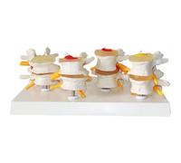 Modèle combiné en 4 Parties Lésions Normales La Colonne vertébrale et Lombaire Les lésions du Rachis Lombaire Show A Disc Disease Medicine Theory Pathological Models