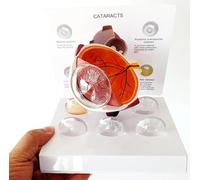 Modèle D’œil De Cataracte, Réplique D’Un œil avec des Conditions De Cataracte pour L’enseignement De L’Anatomie Et De La Physiologie Humaines, Modèle D’Anatomie pour Le Cabinet Médical Et L