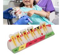Modèle D'affichage des Caries, Modèle de Dent de Carie Dentaire Modèle D'étude Comparative des Dents Bains de Bouche Parodontaux Modèle D'étude Comparative des Dents Modèle de